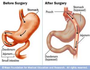 RNY-Diagram-Mayo-Clini